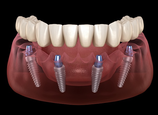 All-on-4 Dental Implants Denver, CO
