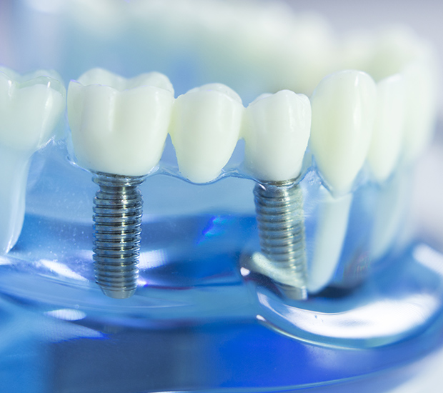 Denver Dental Implants